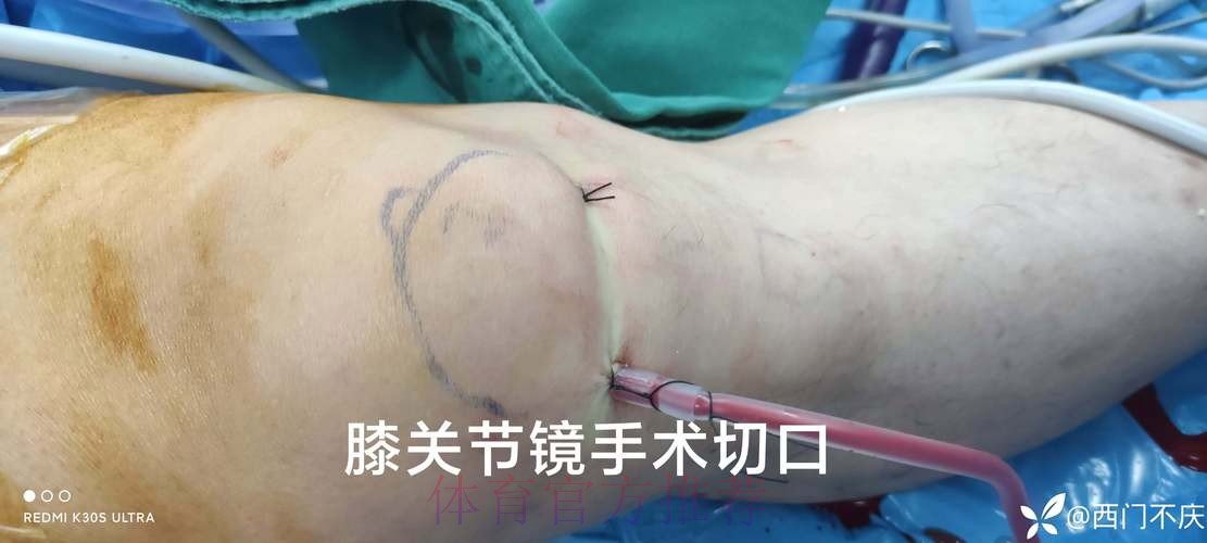 官方：阿拉巴成功接受了左膝内侧半月板撕裂手术